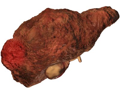 Cancerous Liver