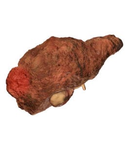 Cancerous Liver