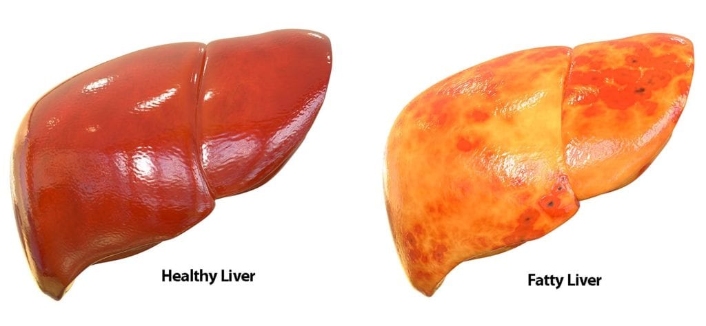 Healthy Liver v. Fatty Liver