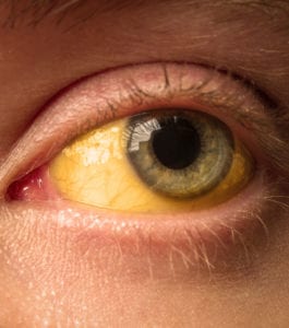 Jaundice Eye