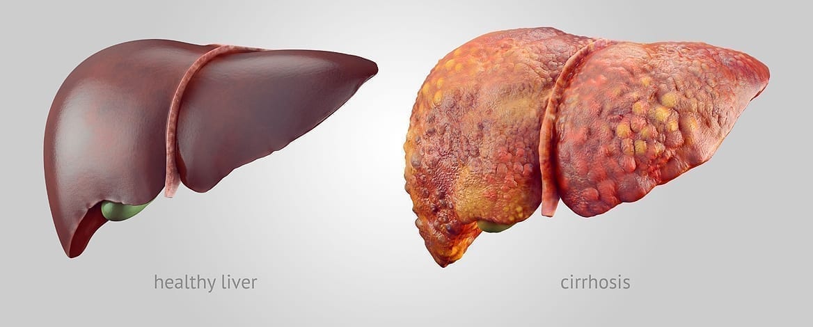 Healthy versus Cirrhotic Liver